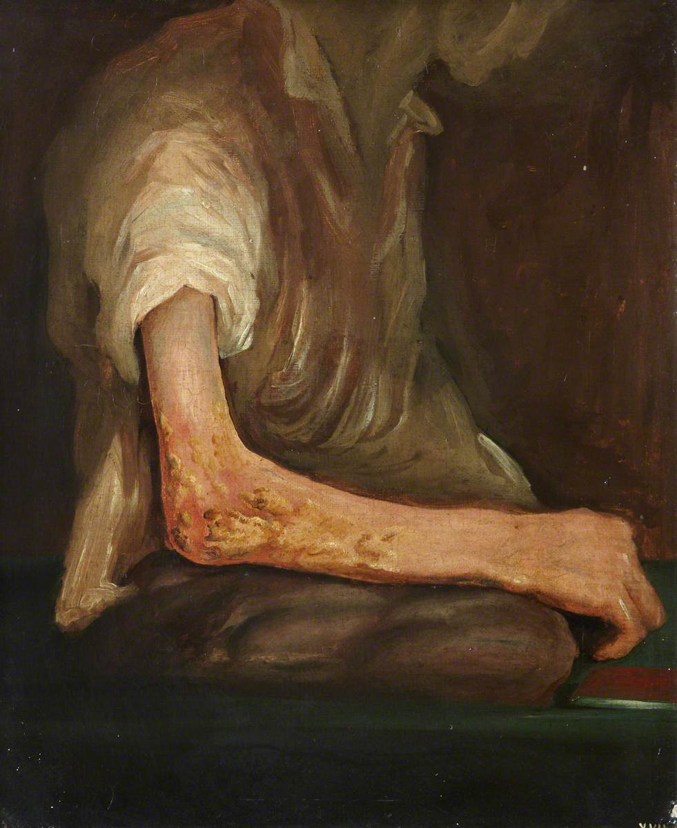 The Wounded following the Battle of Corunna: Musket Ball Wound of Elbow by Charles Bell
